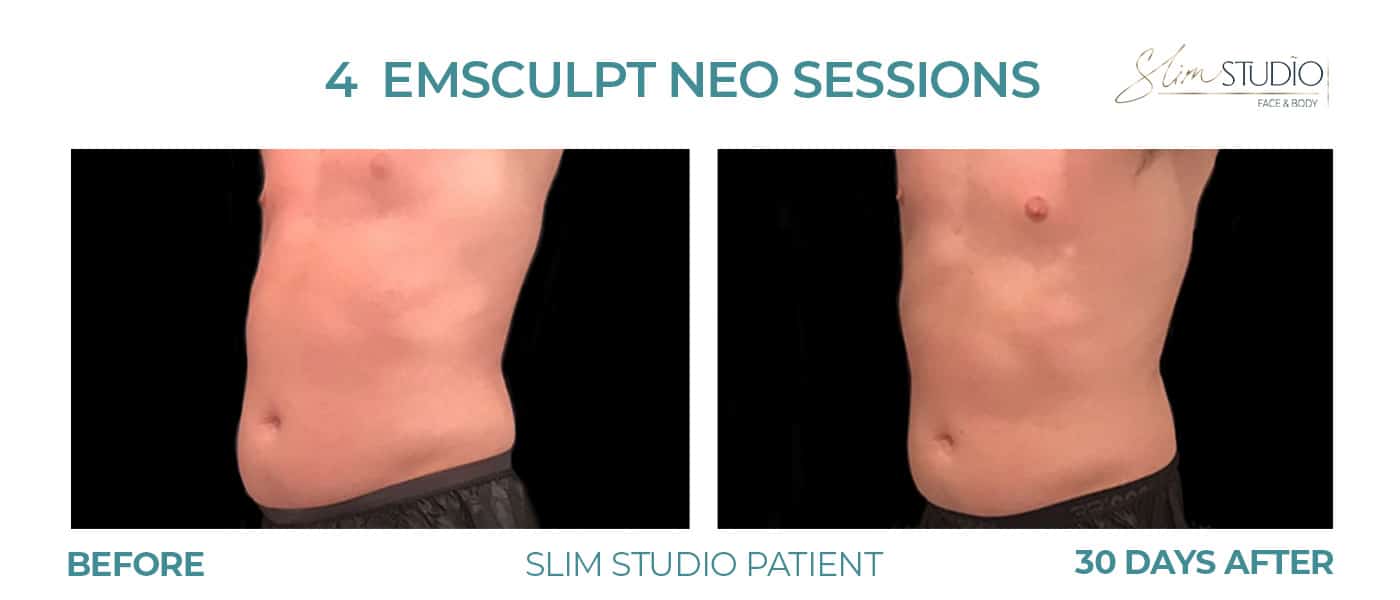 Before and After Image: EMSculpt NEO - left-front-oblique