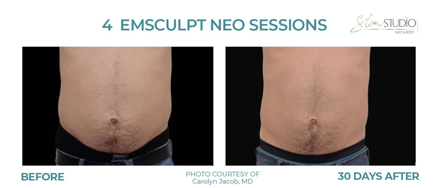 Before and After Image: EMSculpt NEO - front