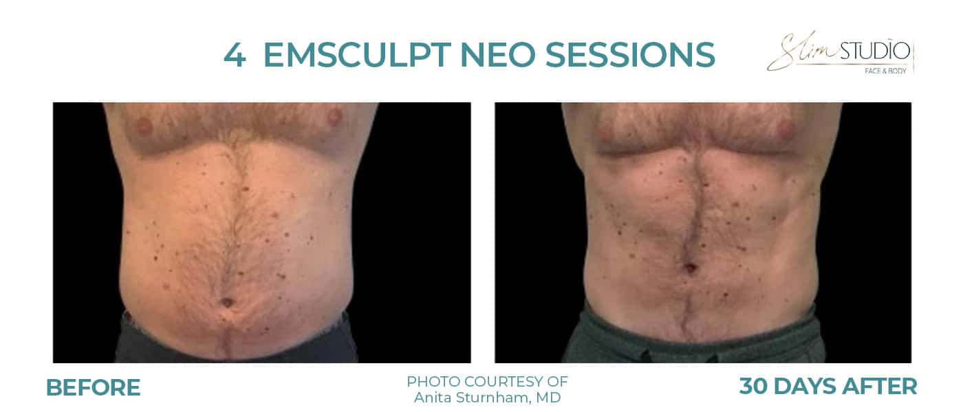Before and After Image: EMSculpt NEO - front