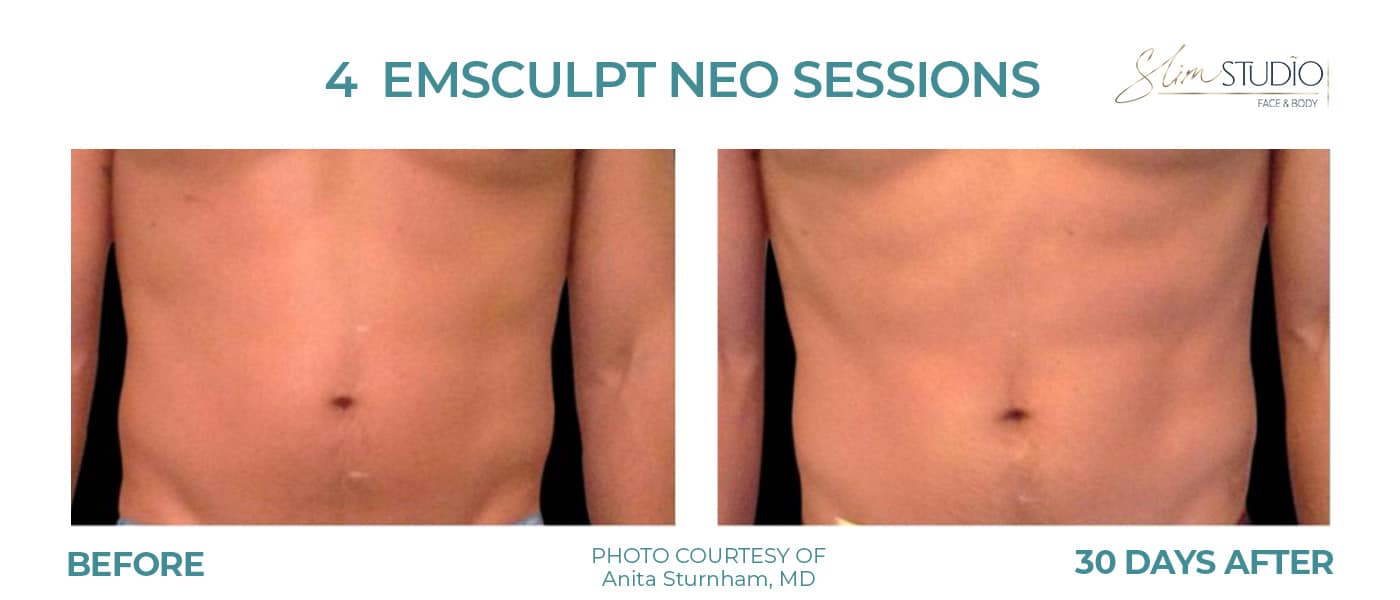 Before and After Image: EMSculpt NEO - front