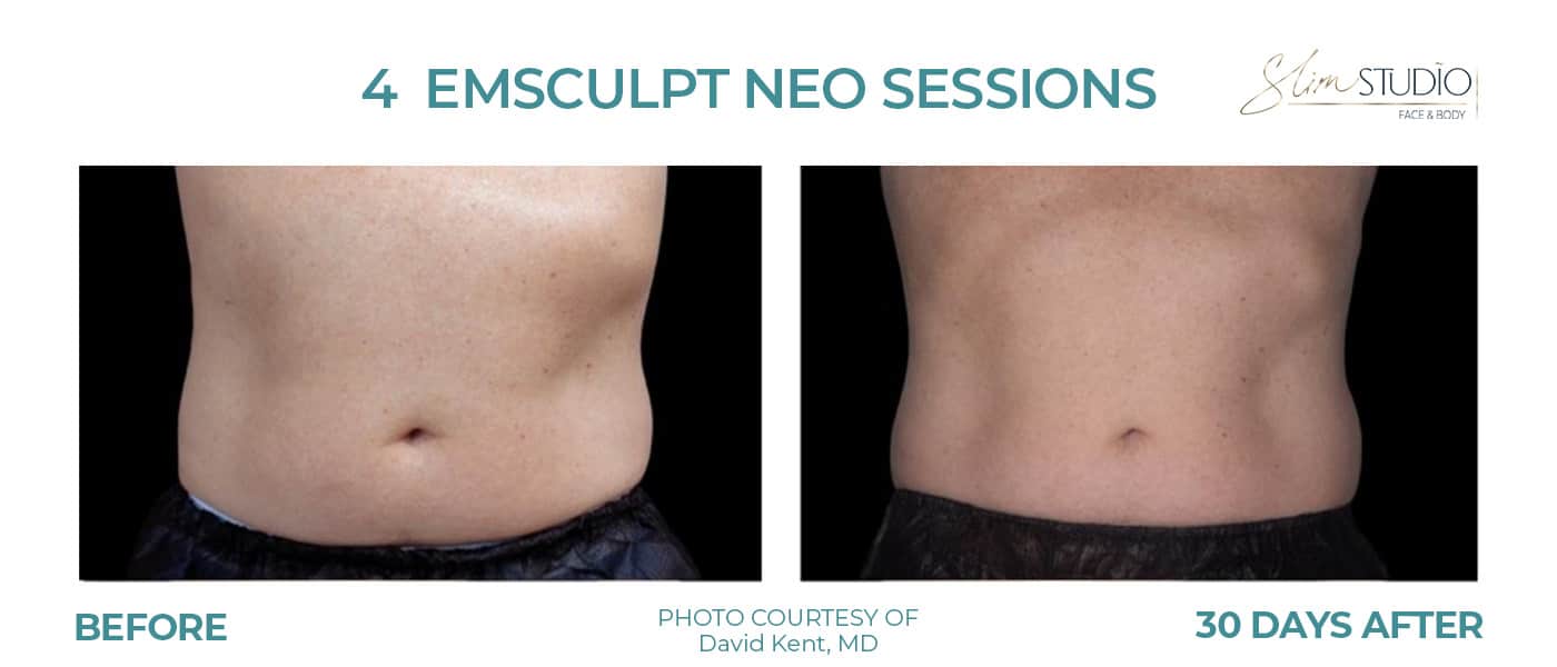 Before and After Image: EMSculpt NEO - front