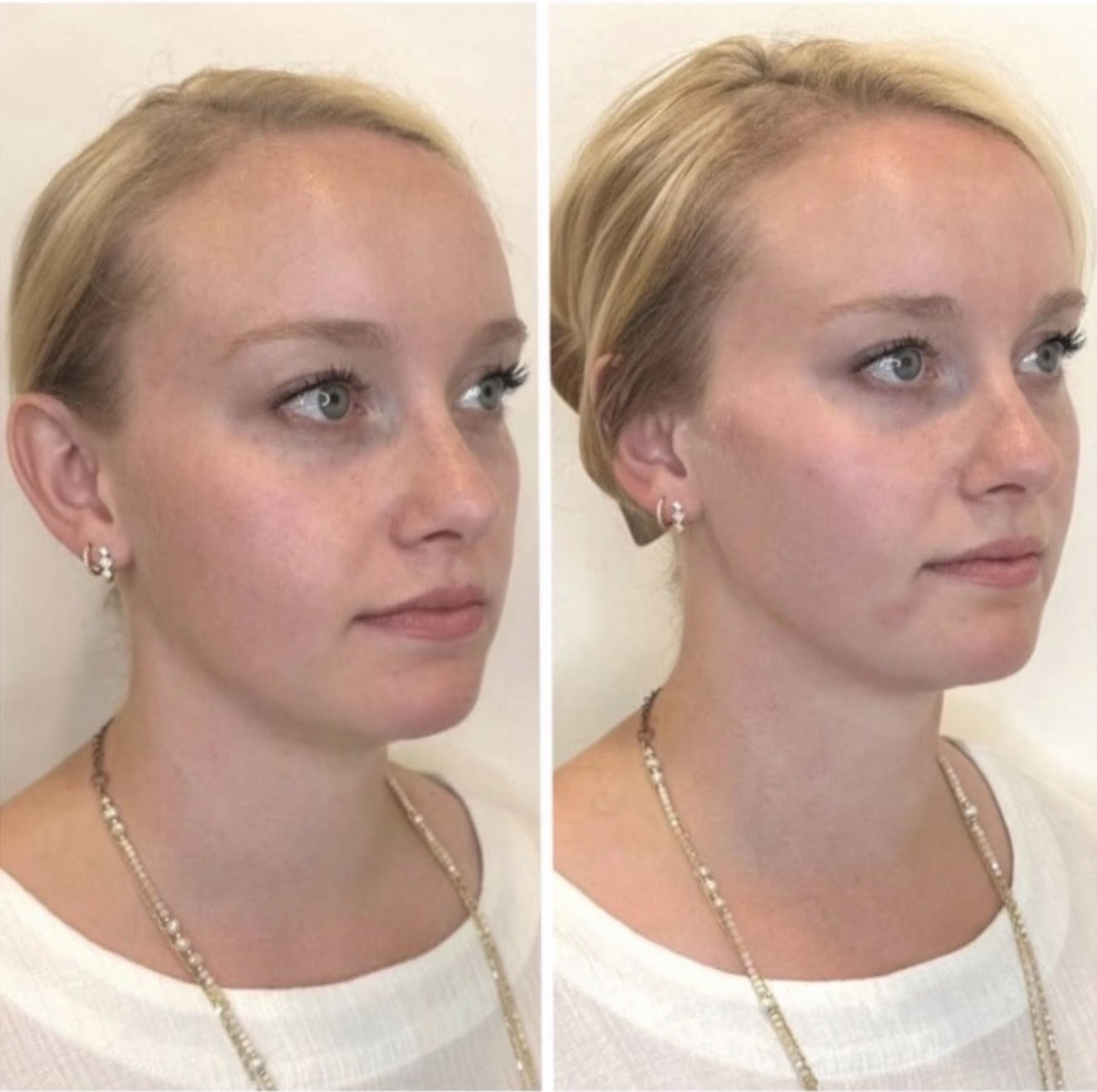 Before and After Image: Cheek enhancement with ha dermal filler - right-front-oblique