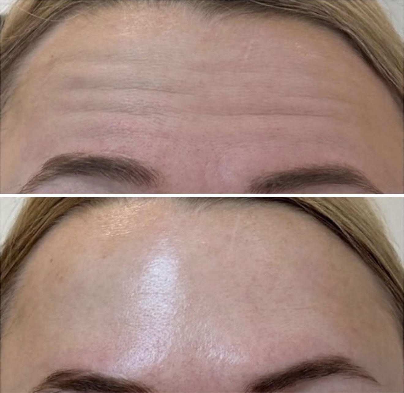 Before and After Image: Forehead treatment with Botox - front