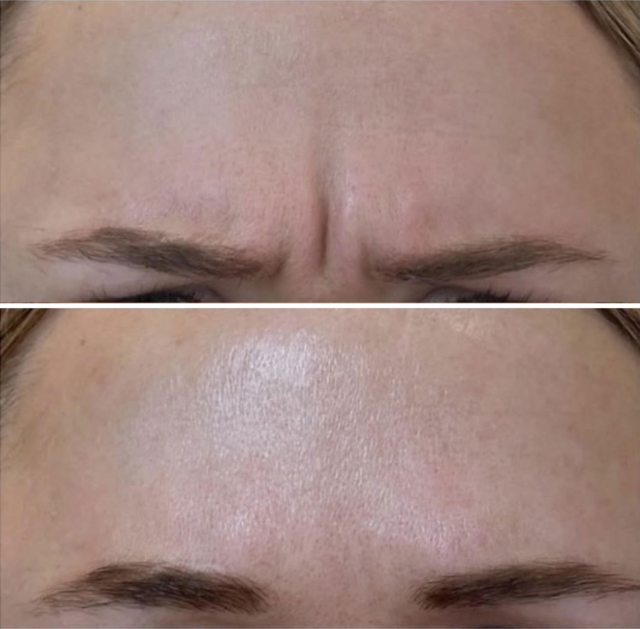 Before and After Image: Glabella frown line treatment with Botox - front