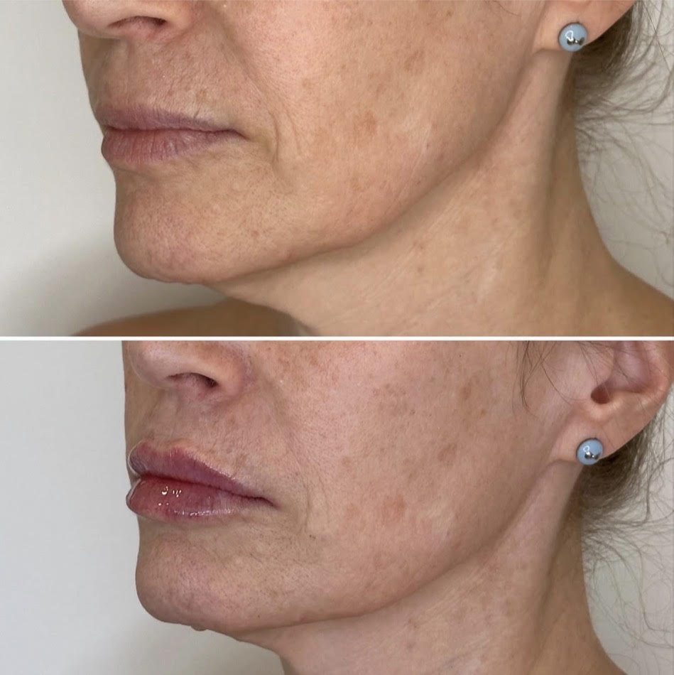 Before and After Image: Lip enhancement and balancing with dermal filler - left-front-oblique