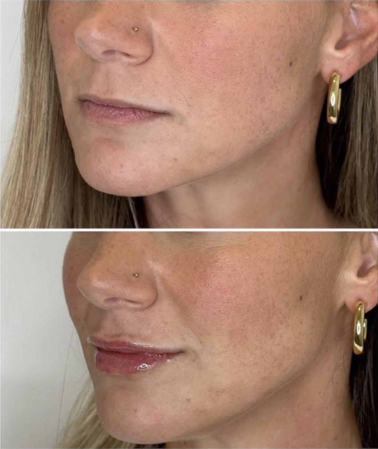 Before and After Image: Lip enhancement with ha dermal filler - left-front-oblique