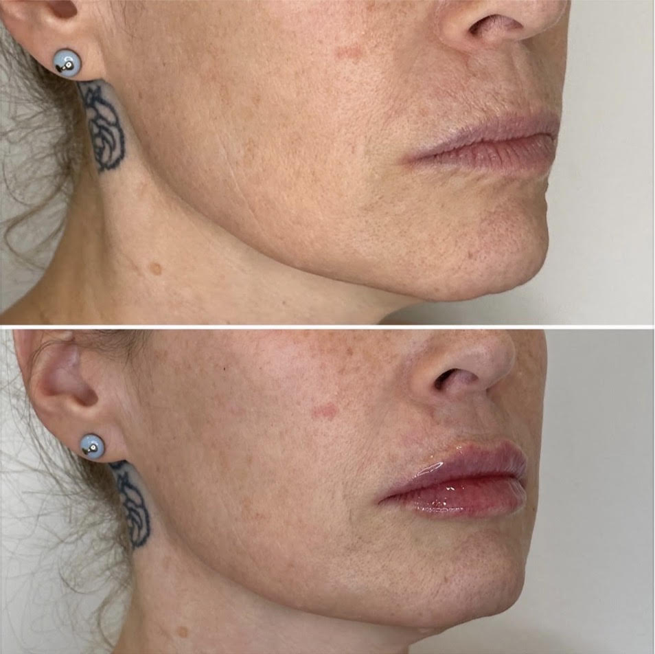 Before and After Image: Lip enhancement with ha dermal filler - right-front-oblique