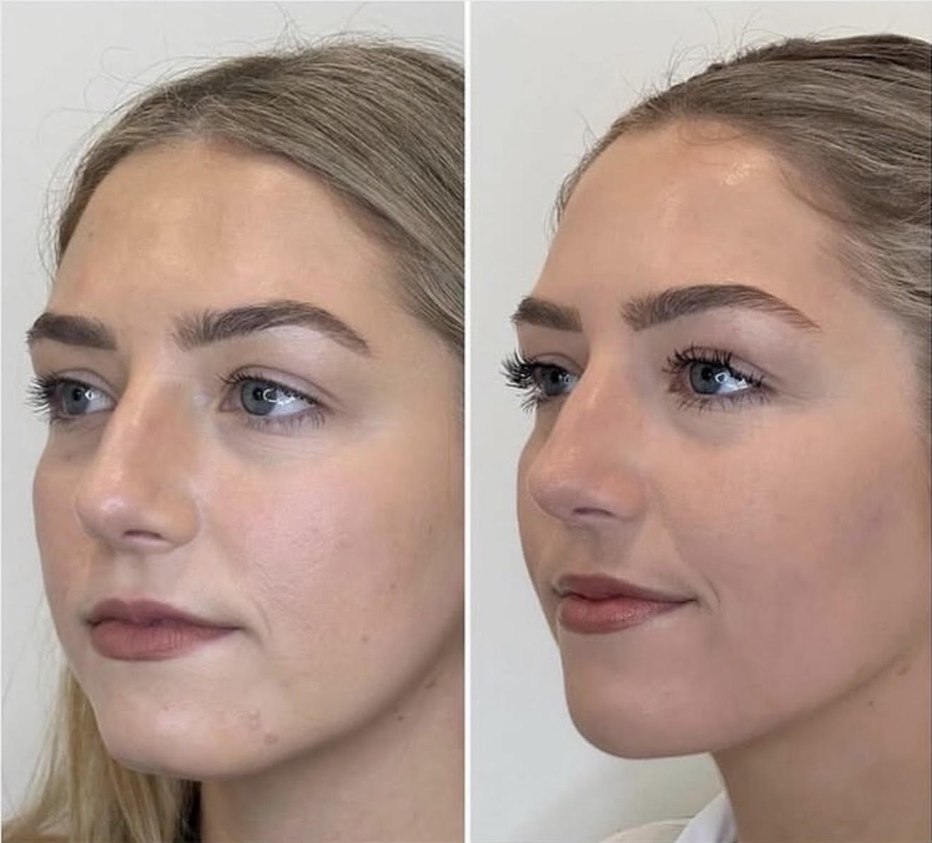 Before and After Image: Facial slimming and balancing, chin and cheek enhancement and jaw defining with neurotoxin and ha dermal filler - left-front-oblique