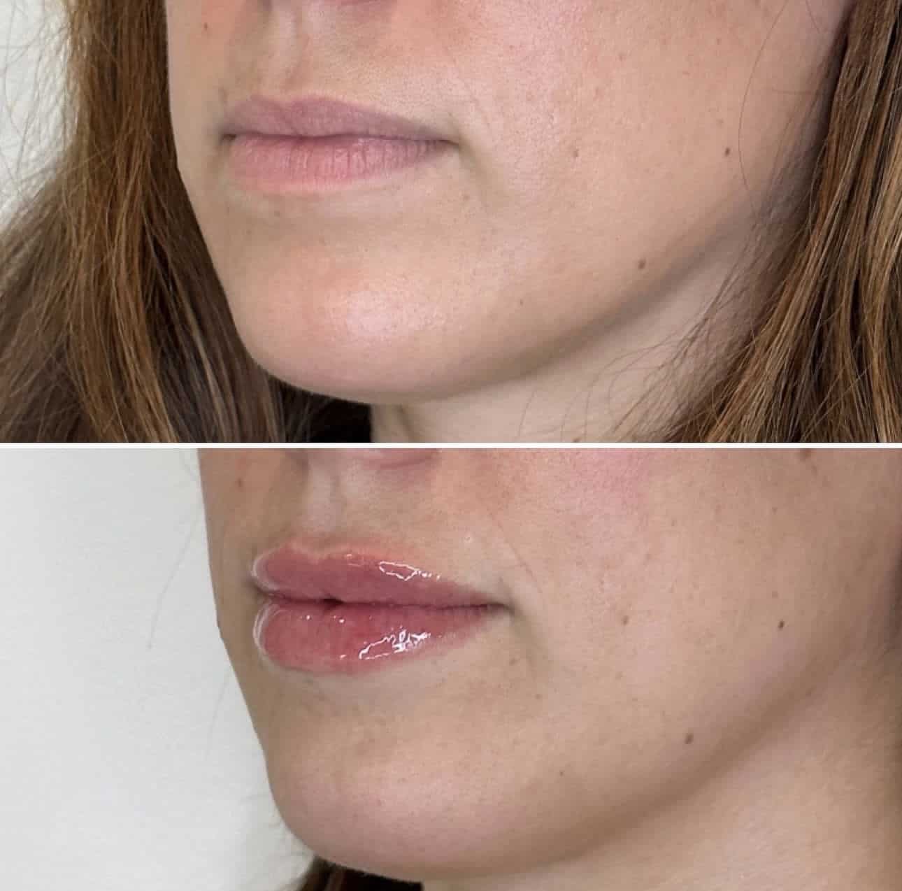 Before and After Image: Lip Filler with Juvederm - left-front-oblique
