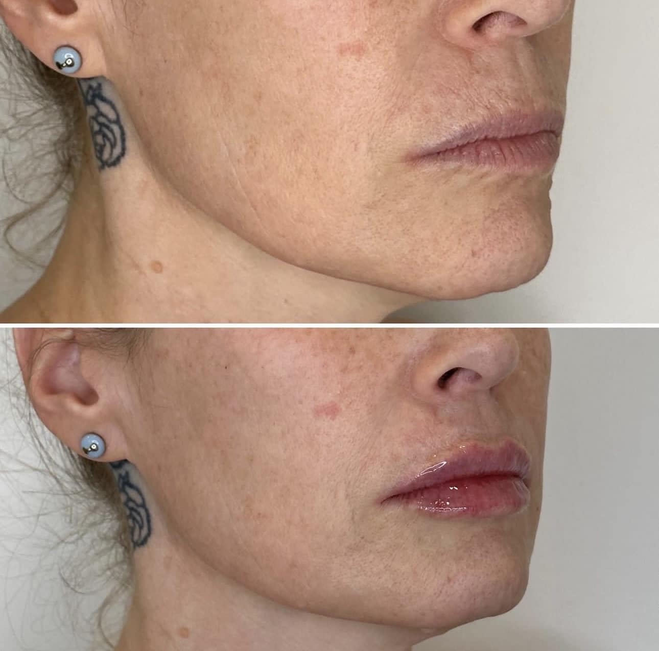 Before and After Image: Lip Filler with Juvederm - right-front-oblique