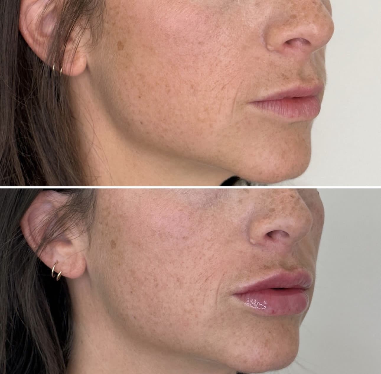 Before and After Image: Lip Filler with Juvederm - right-front-oblique