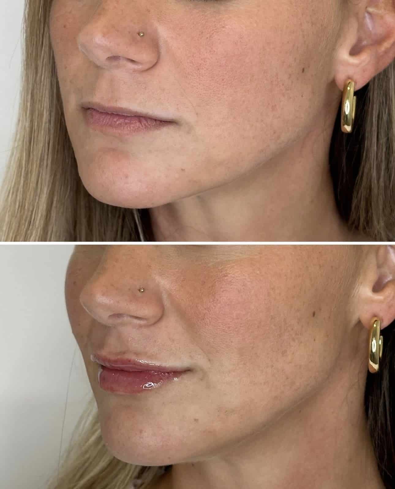 Before and After Image: Lip Filler with Juvederm and Botox to fix a gummy smile - left-front-oblique