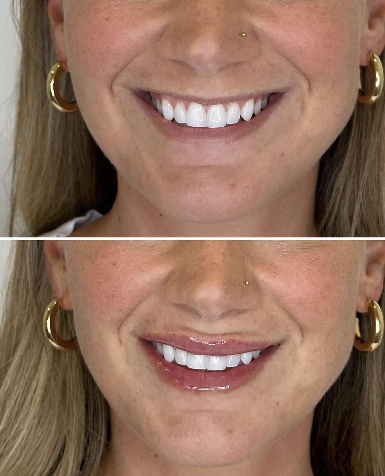 Before and After Image: Lip Filler with Juvederm - front