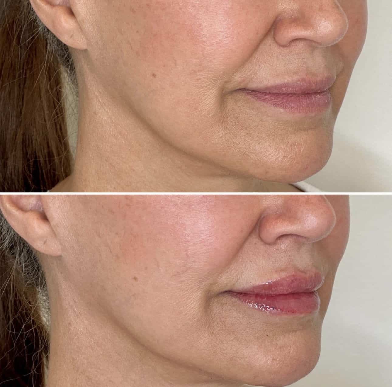 Before and After Image: Lip Filler with Juvederm - right-front-oblique