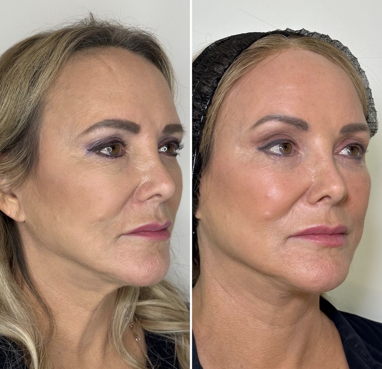Before and After Image: Lip Filler and Nasolabial Fold Treatment with Juvederm - right-front-oblique