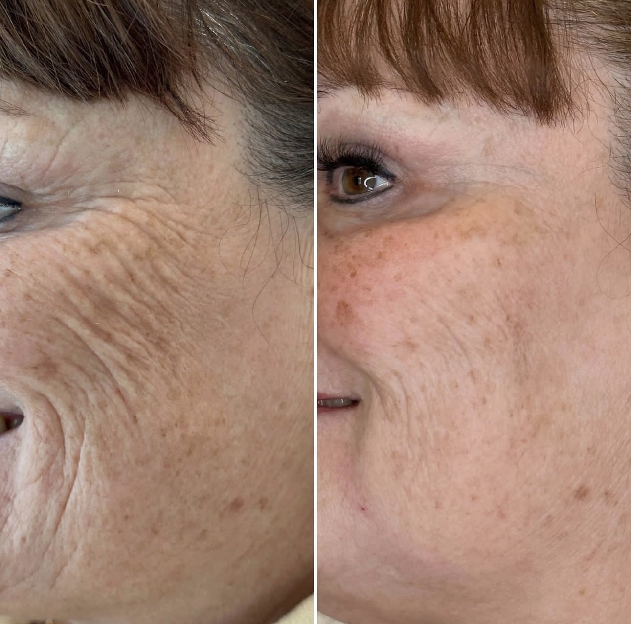 Before and After Image: Mid-face restoration and subtle volume with Sculptra - left-front-oblique