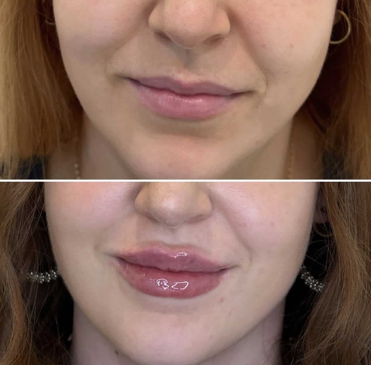 Before and After Image: Lip Filler with Juvederm - front