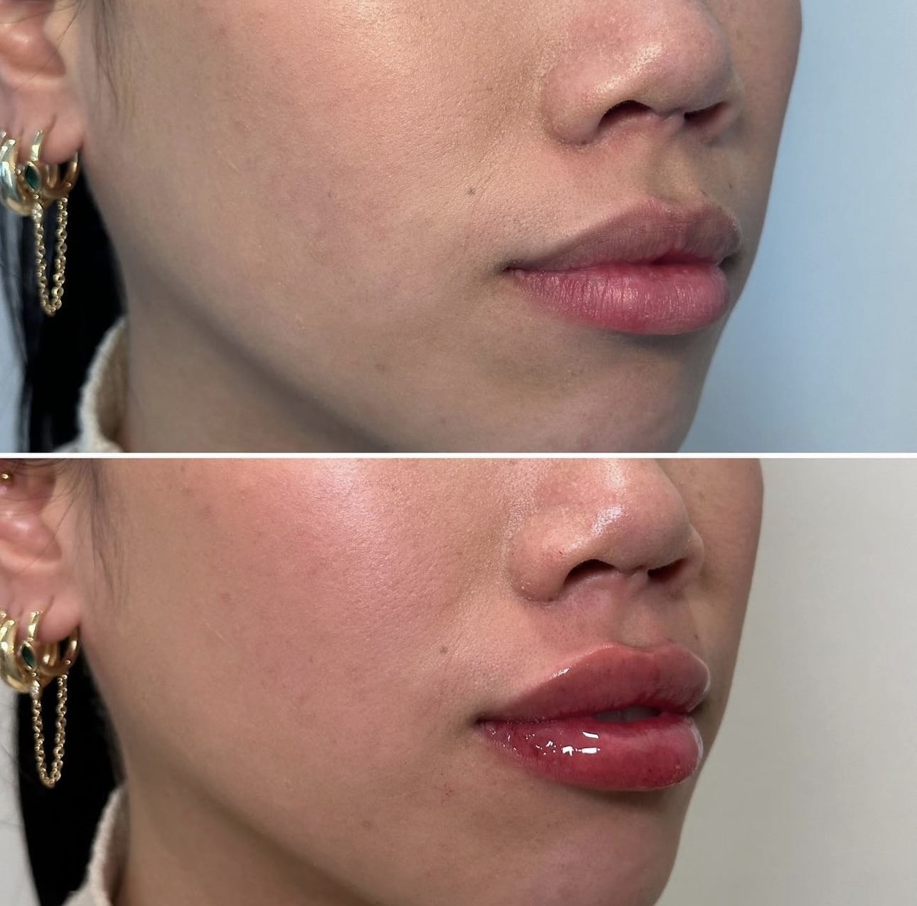 Before and After Image: Lip Filler with Juvederm - right-front-oblique