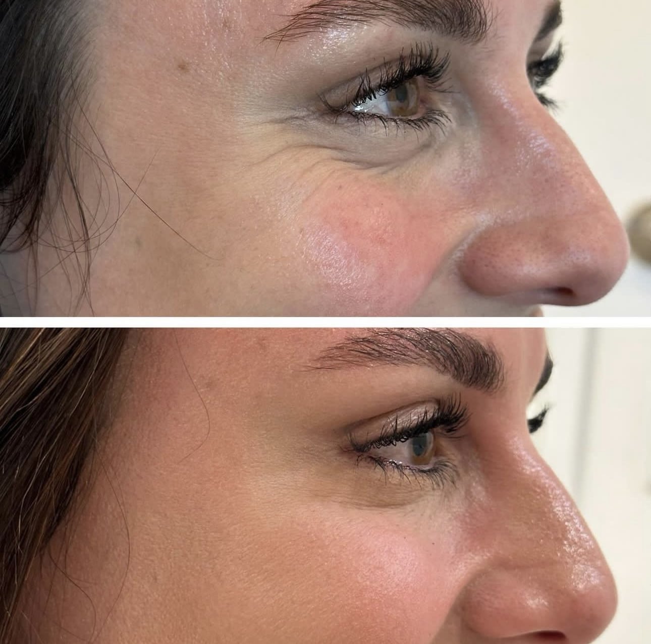 Before and After Image: Orbital/eye creases/crow’s feet smoothing with Botox and Sculptra - right-side