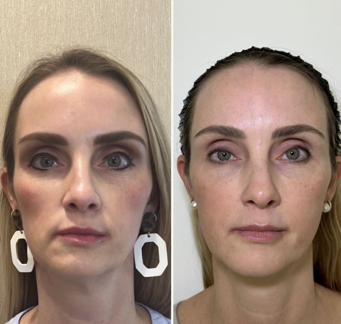 Before and After Image: Full Facial Balancing with Sculptra - front