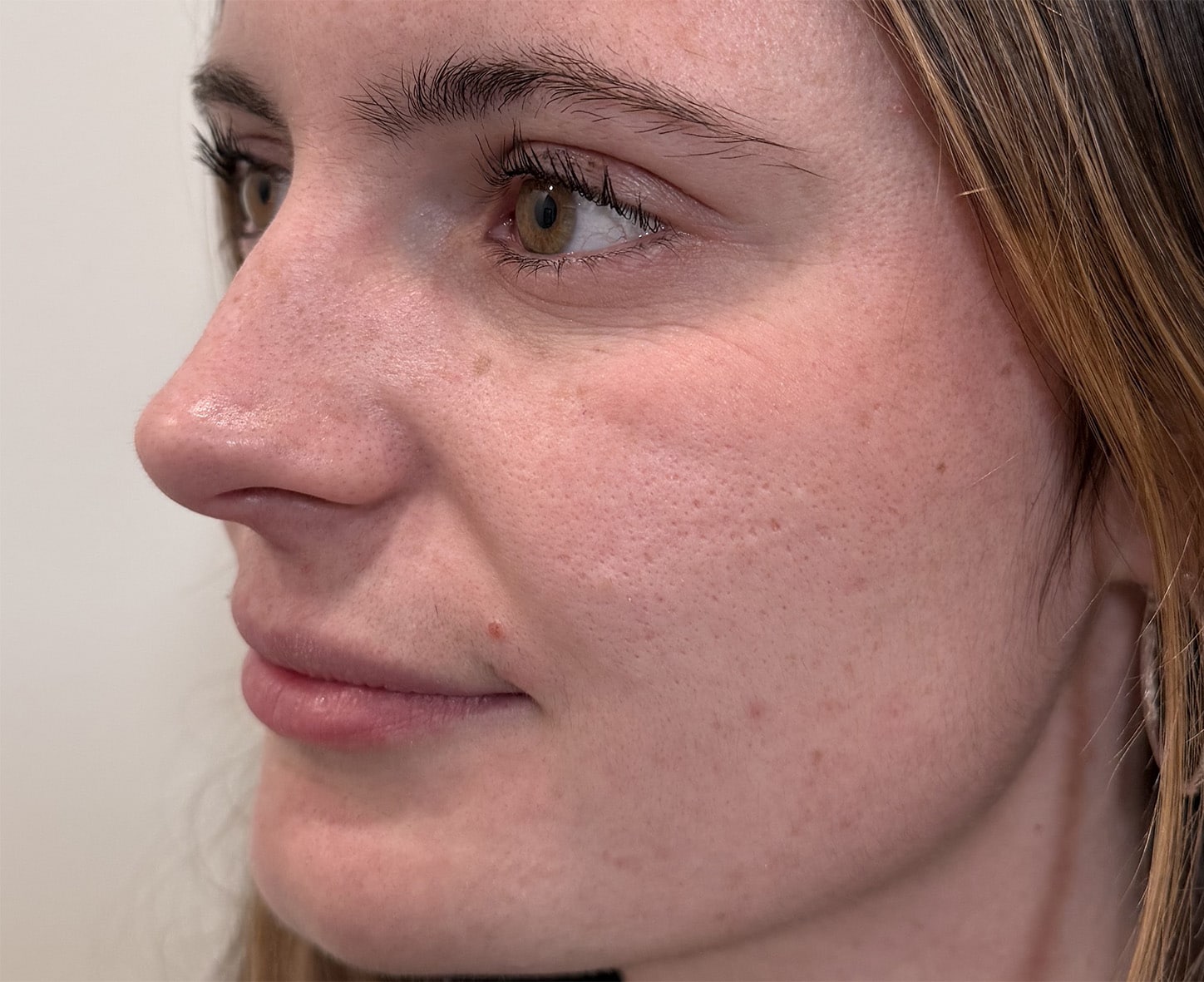 Before Image: Lip Filler with Juvederm - left-front-oblique