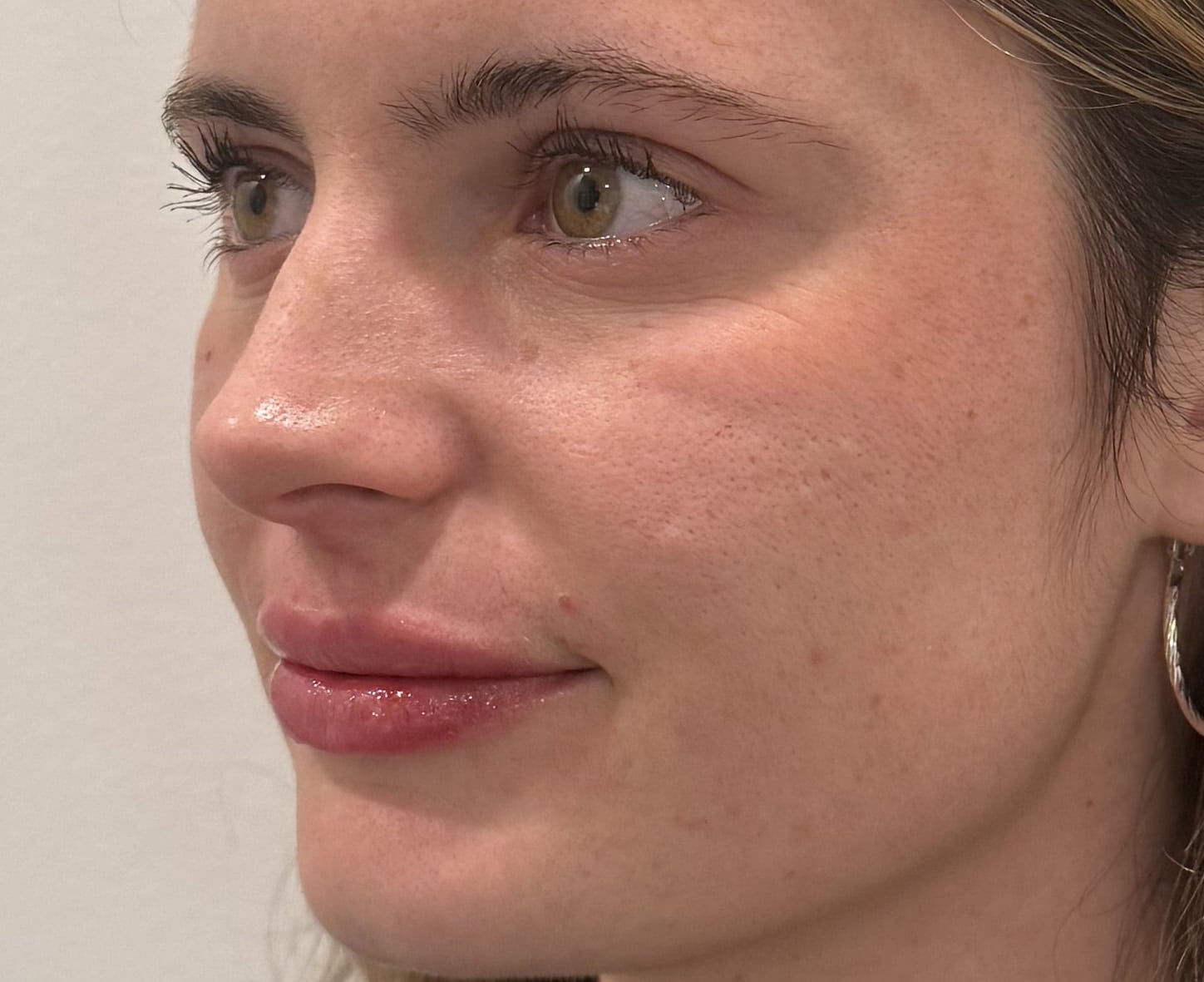 After Image: Lip Filler with Juvederm - left-front-oblique