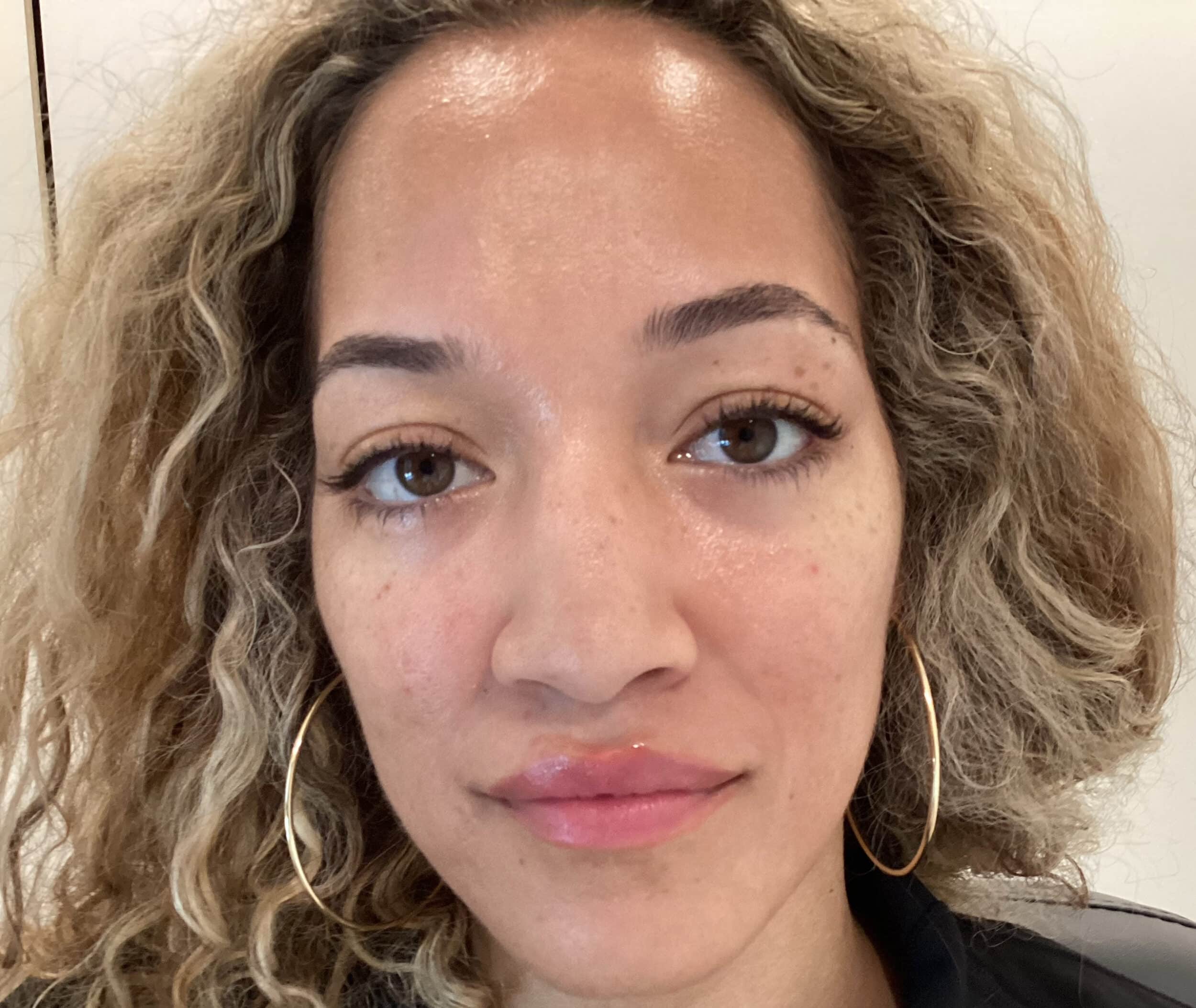 After Image: Forehead smoothing with Botox - front