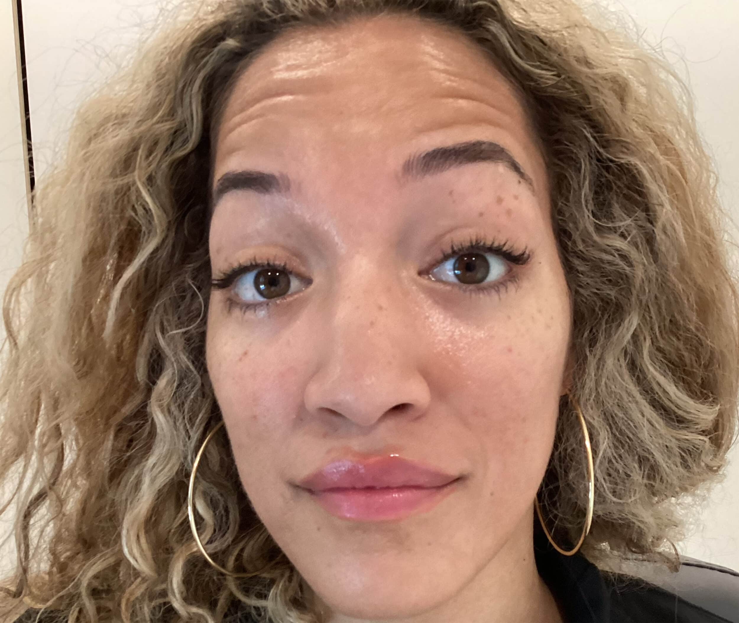 Before Image: Forehead smoothing with Botox - front