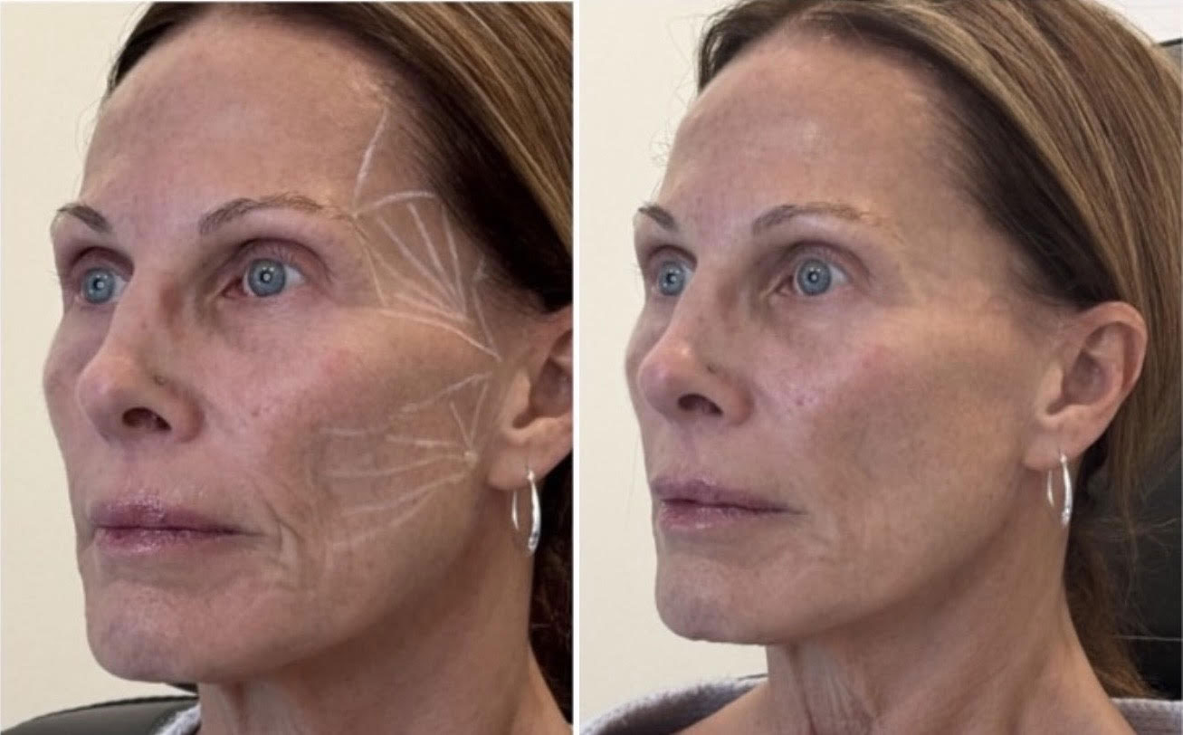 Before and After Image: Sculptra and ha dermal filler - left-front-oblique