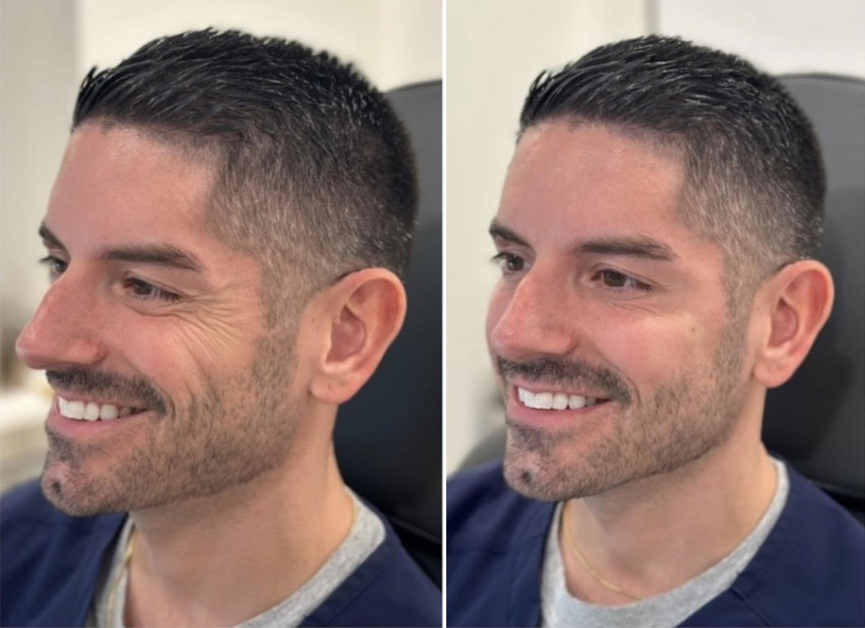 Before and After Image: Male Sculptra and Botox - left-front-oblique
